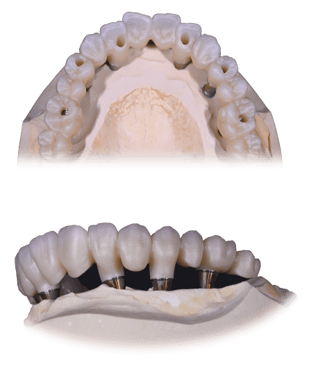 Puente de carga dental con implantes, diseñado para restaurar la función masticatoria y estética en pacientes con pérdida de dientes.