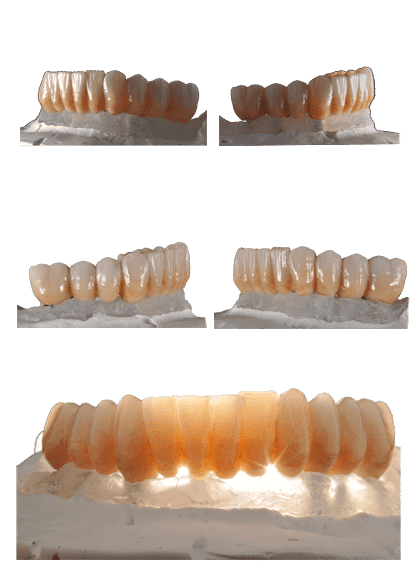 Resina dental de alta calidad para prótesis y restauraciones, ideal para laboratorios y clínicas dentales. Material duradero y estético que garantiza resultados precisos y duraderos.