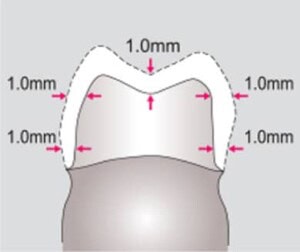 Algoritmo para medición de espacio entre dientes, mostrando distancias de 1.0 mm en la impresión dental, dirigido a profesionales en suministros dentales.