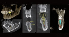 Implantes y suministros dentales en radiografías, equipo especializado en odontología para diagnósticos precisos y tratamientos efectivos, garantizando atención de calidad.