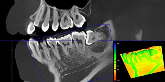 Tratamiento digital de radiografía dental mostrando detalles precisos de dientes y encías en una imagen en escala de grises con análisis de color para diagnósticos.