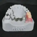 Modelo de prótesis dental fija en resina y metal, mostrando estructura metálica y dientes artificiales, utilizado para restaurar la función y estética de la sonrisa.