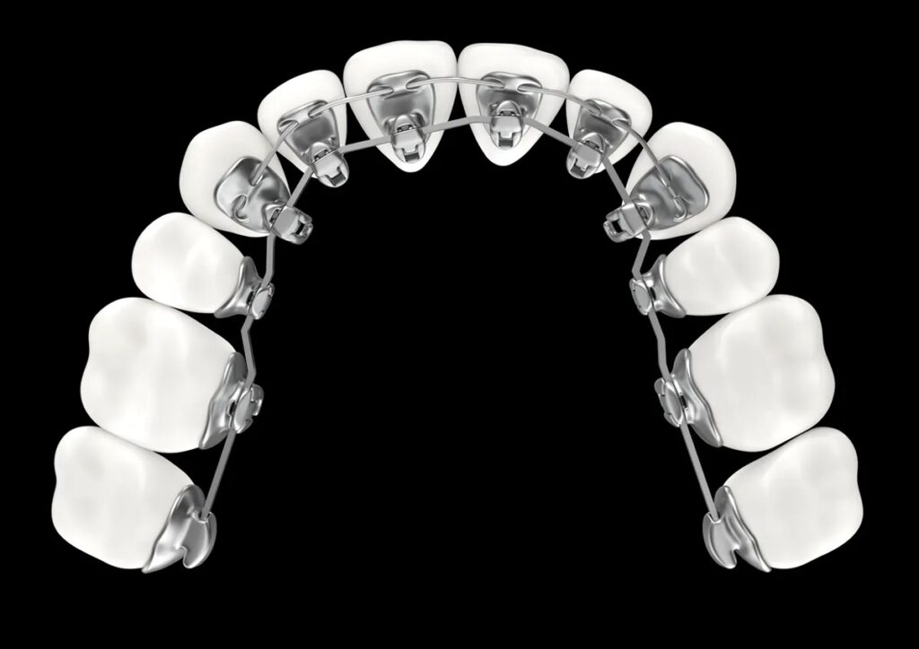 Imagen de un arco de brackets metálicos en dientes superiores, mostrando un tratamiento de ortodoncia para corregir la alineación dental.