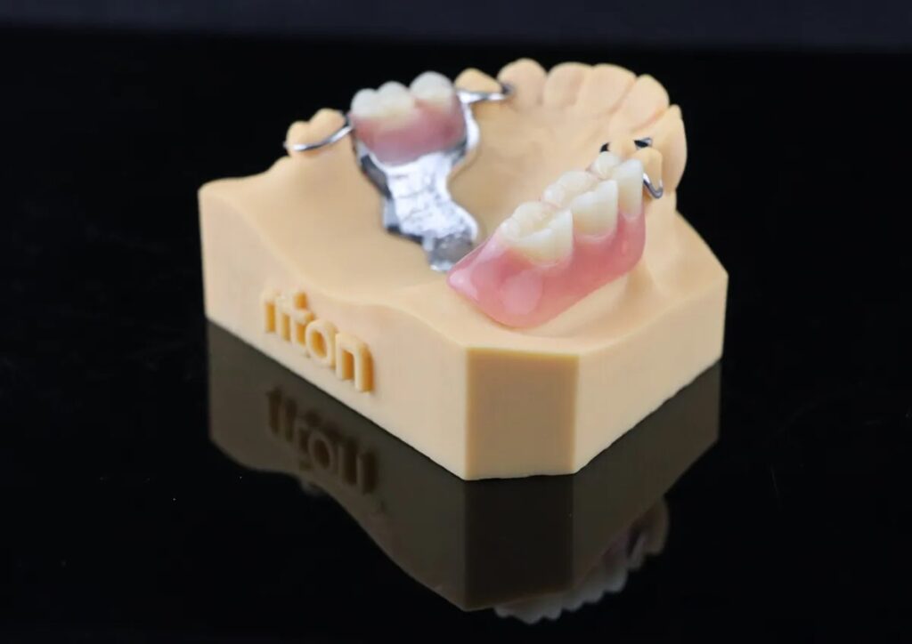 Prototipo de prótesis dental en modelo de encía con estructura metálica y dientes artificiales, utilizado para planificación y fabricación de restauraciones dentales.