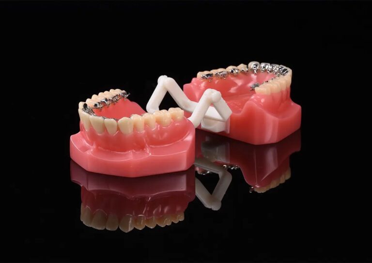 Impresora 3D de metal M-150 17 Coronas dentales con brackets y prótesis en modelo dental, mostrando diferentes tipos de restauraciones y aparatos ortodónticos para tratamientos dentales.