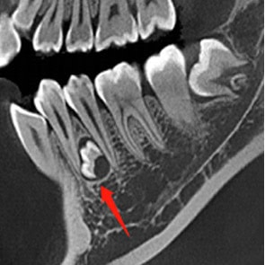Caries Dental y Dientes Supernumerarios