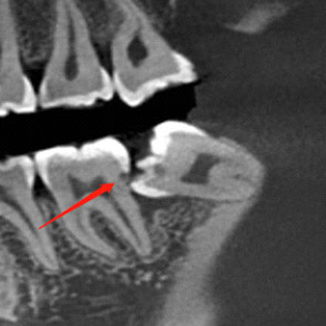 Caries Disto-proximal