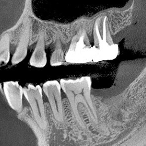 Tratamiento de Conducto Radicular