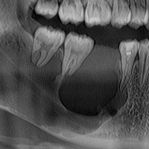 Dientes Flojos