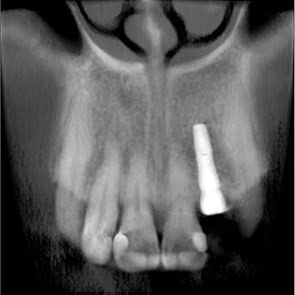 FOV Pequeño para Implantar