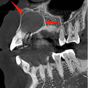 Quiste Apical