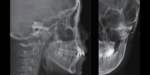 Mediciones Cefalométricas Laterales