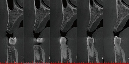 Corte de Imagen para Implantes