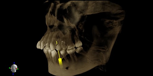 IA + Colocación Automática de Implantes