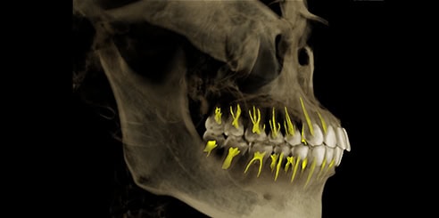 IA + Segmentación Dental de Conductos Radiculares