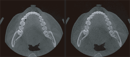Equipo de radiografía dental en consulta odontológica, mostrando una imagen de rayos X de la boca con enfoque en los dientes y la estructura ósea maxilar.