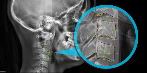 IA + Predicción de Edad Ósea Observando la Columna Cervical