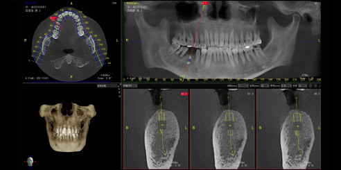 IA + Implante Oral