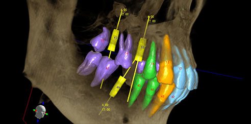 IA + Colocación de Múltiples Implantes con un Clic