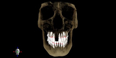 IA + Simulación de Extracción Dental