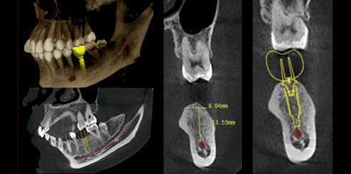 Simulación de Implantes