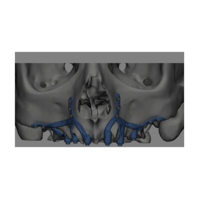 Modelo 3D de un sistema de implantes dentales en la mandíbula, utilizado en procedimientos odontológicos.