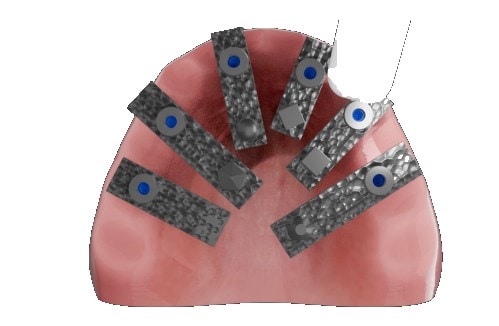 Imagen de implantes dentales con tornillos de titanio y componentes para procedimientos odontológicos.
