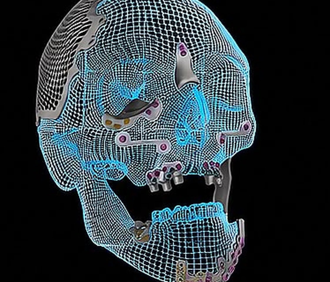Master Program en Implantes Dentales Personalizados, AB Dental Academy 2 Diseño digital de un implante subperióstico personalizado sobre maxila y mandíbula, con tornillos de fijación y pilares protésicos