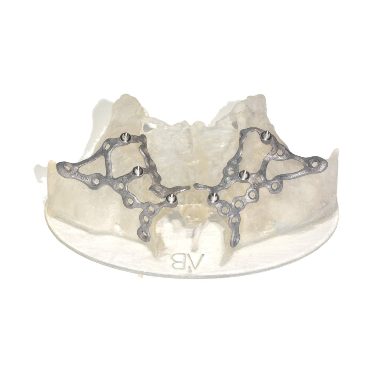 Dos implantes subperiósticos personalizados de titanio AB Dental atornillados sobre un modelo de maxilar en resina translúcida