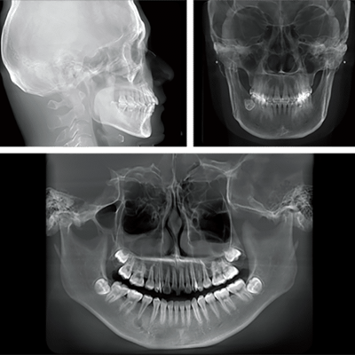 Radiografías dentales mostrando estructura ósea facial y articulaciones temporomandibulares.